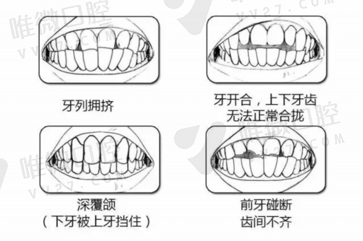 镍铬烤瓷牙可以用几年（烤瓷牙哪一种好*济实用）(图1)